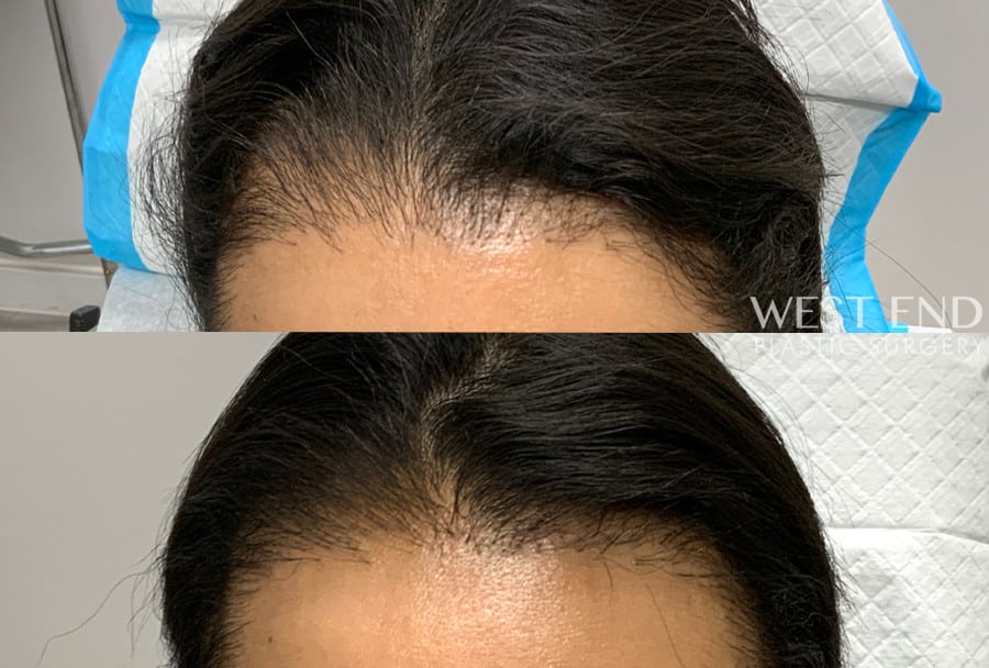 Non-Surgical Hair Growth with PRP