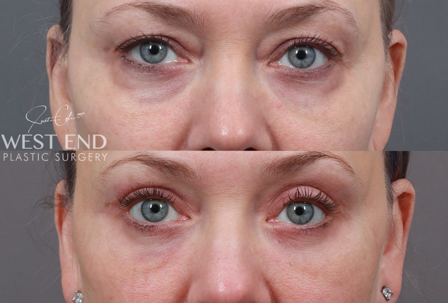 Blepharoplasty, Fat Grafting & CO2 Laser Resurfacing before photo. Individual results may vary.