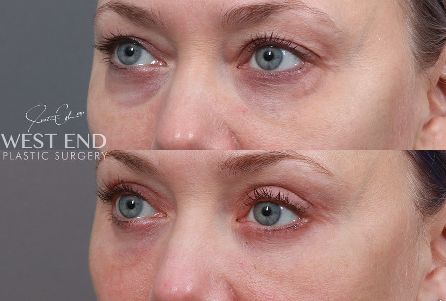 Blepharoplasty, Fat Grafting & CO2 Laser Resurfacing before photo. Individual results may vary.