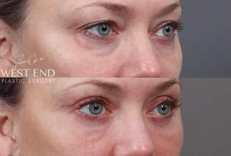 Blepharoplasty, Fat Grafting & CO2 Laser Resurfacing before photo. Individual results may vary.