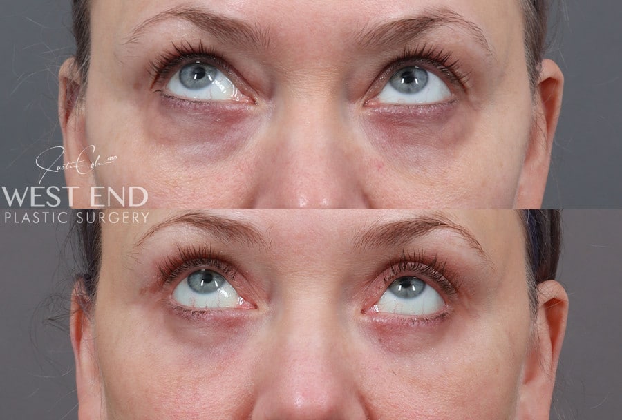 Blepharoplasty, Fat Grafting & CO2 Laser Resurfacing before photo. Individual results may vary.