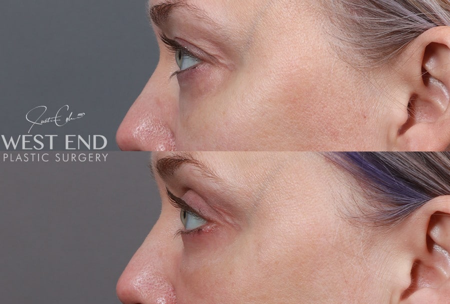 Blepharoplasty, Fat Grafting & CO2 Laser Resurfacing before photo. Individual results may vary.