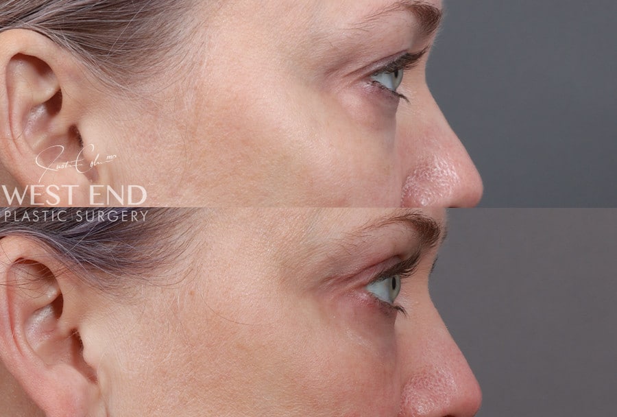 Blepharoplasty, Fat Grafting & CO2 Laser Resurfacing before photo. Individual results may vary.