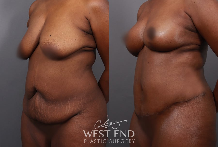 Mommy Makeover (Tummy Tuck & Breast Lift)