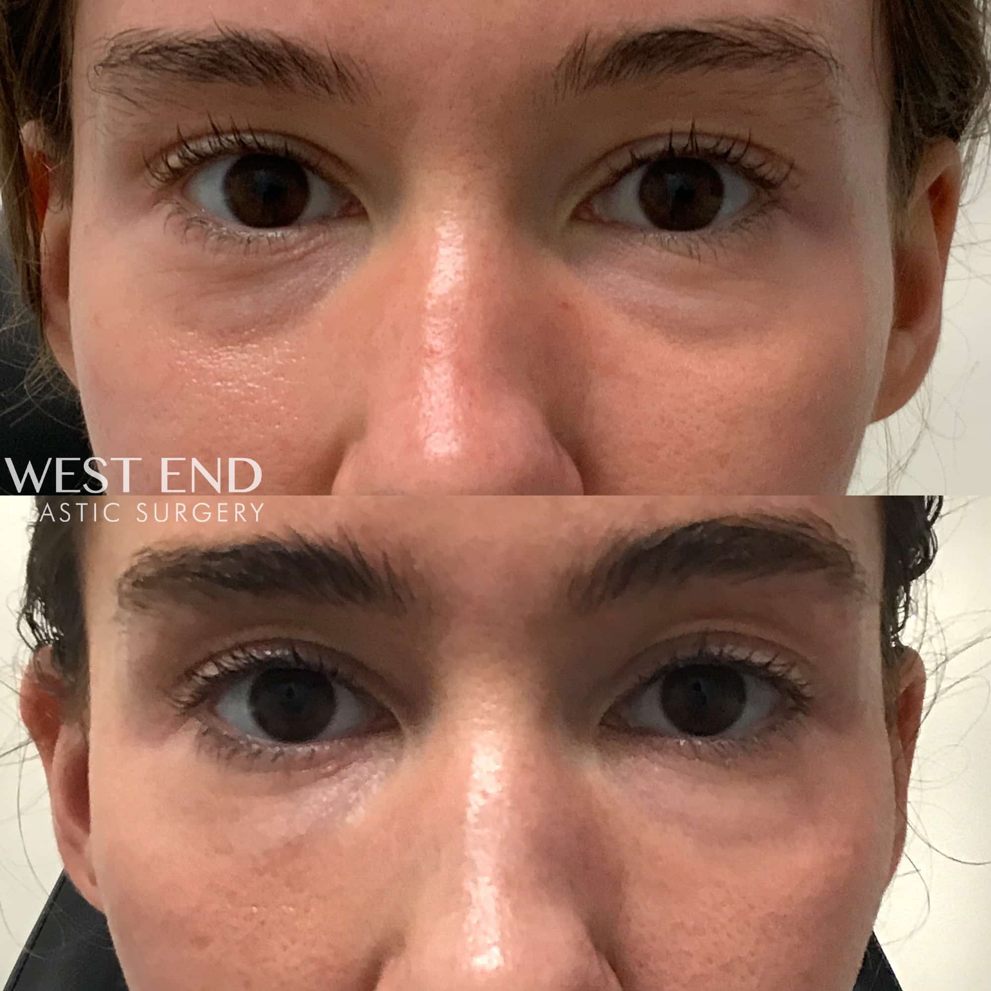 Under-Eye Filler