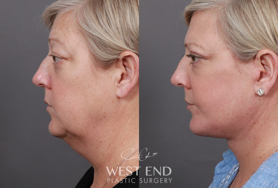 Extended Deep Plane Facelift, Neck Lift, Blepharoplasty, Buccal Fat Reduction & CO2 Resurfacing before photo. Individual results may vary.