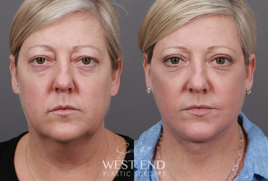 Extended Deep Plane Facelift, Neck Lift, Blepharoplasty, Buccal Fat Reduction & CO2 Resurfacing before photo. Individual results may vary.
