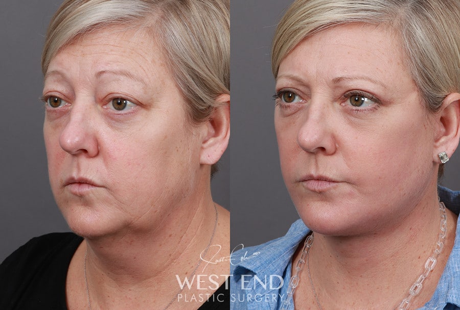 Extended Deep Plane Facelift, Neck Lift, Blepharoplasty, Buccal Fat Reduction & CO2 Resurfacing before photo. Individual results may vary.