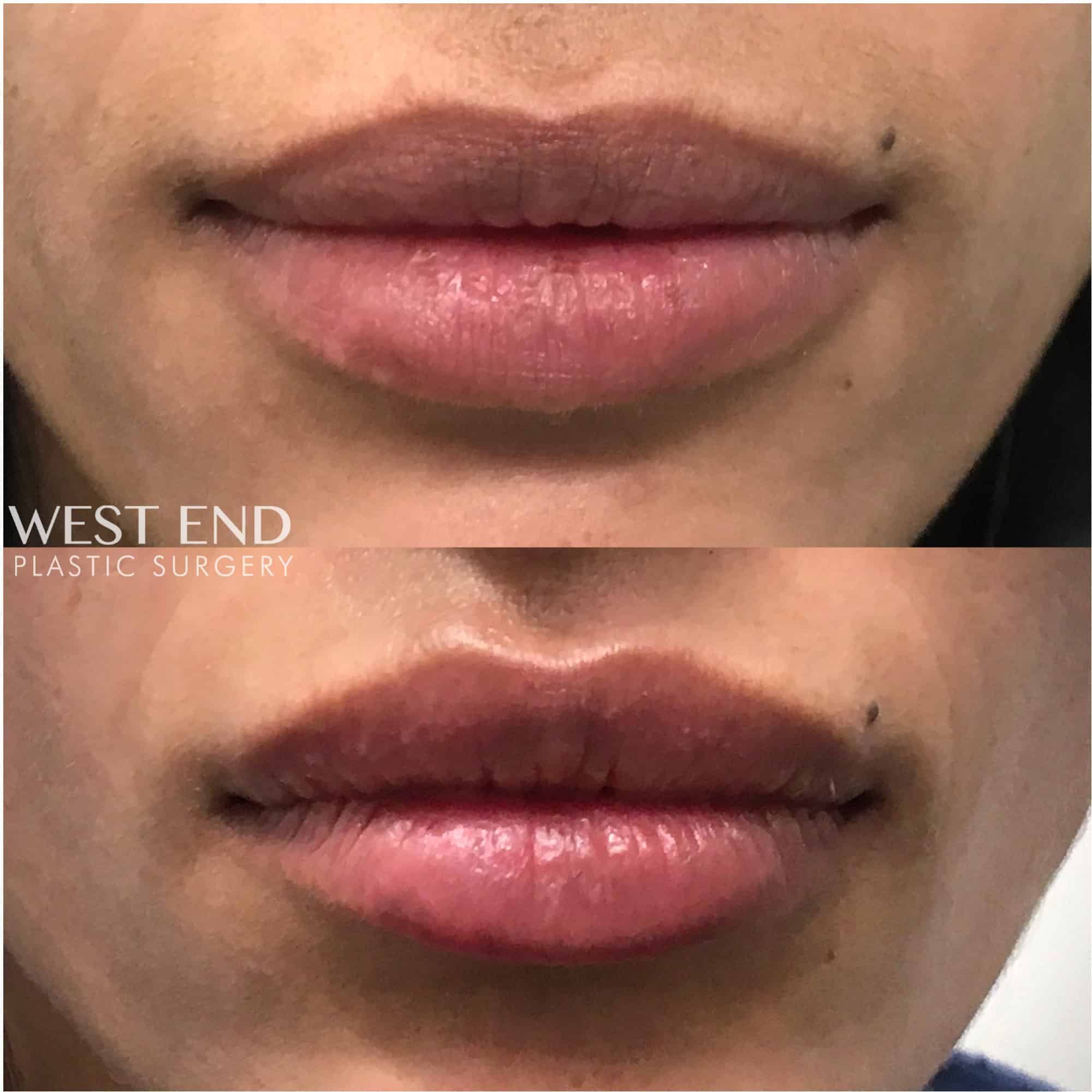 Lip Filler