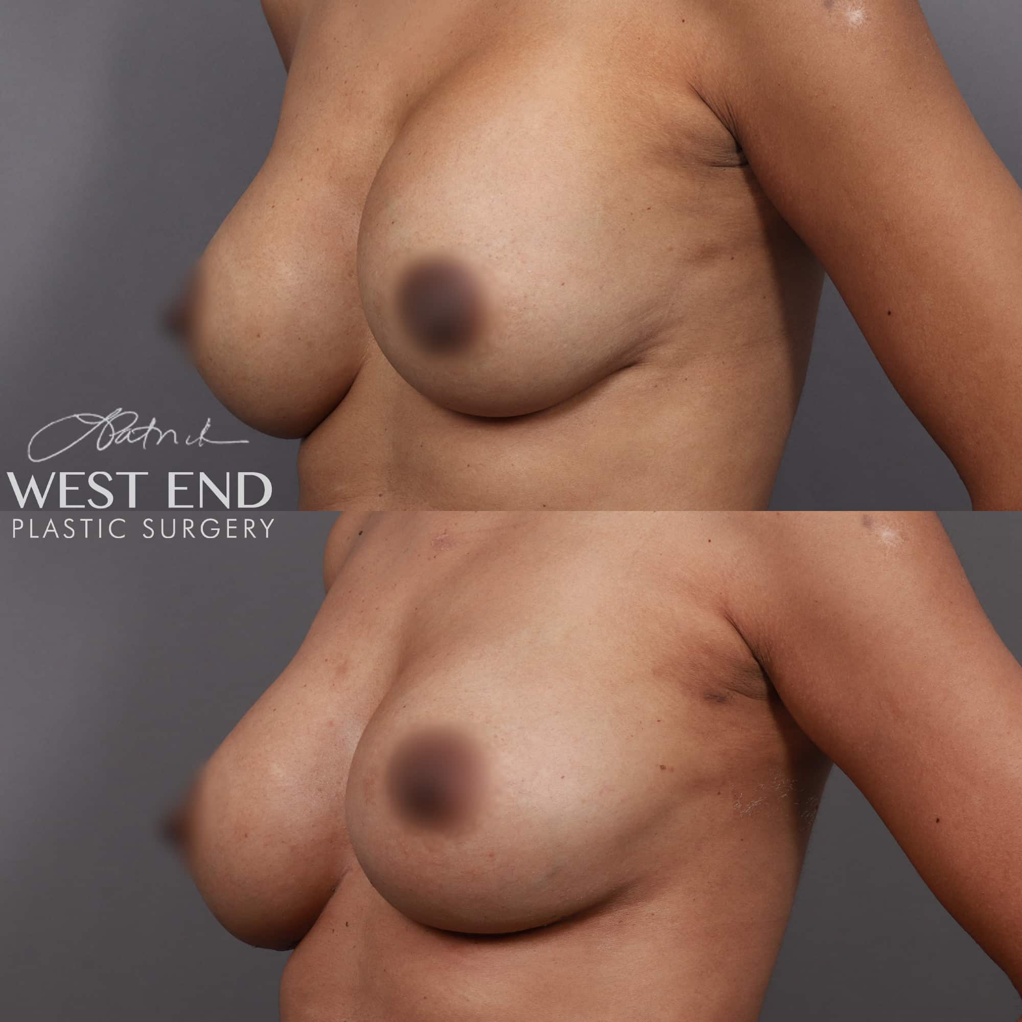 Breast Augmentation Revision & Implant Exchange