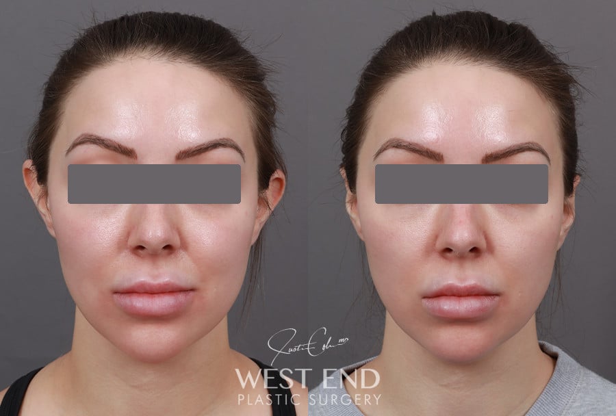 Otoplasty before photo. Individual results may vary.