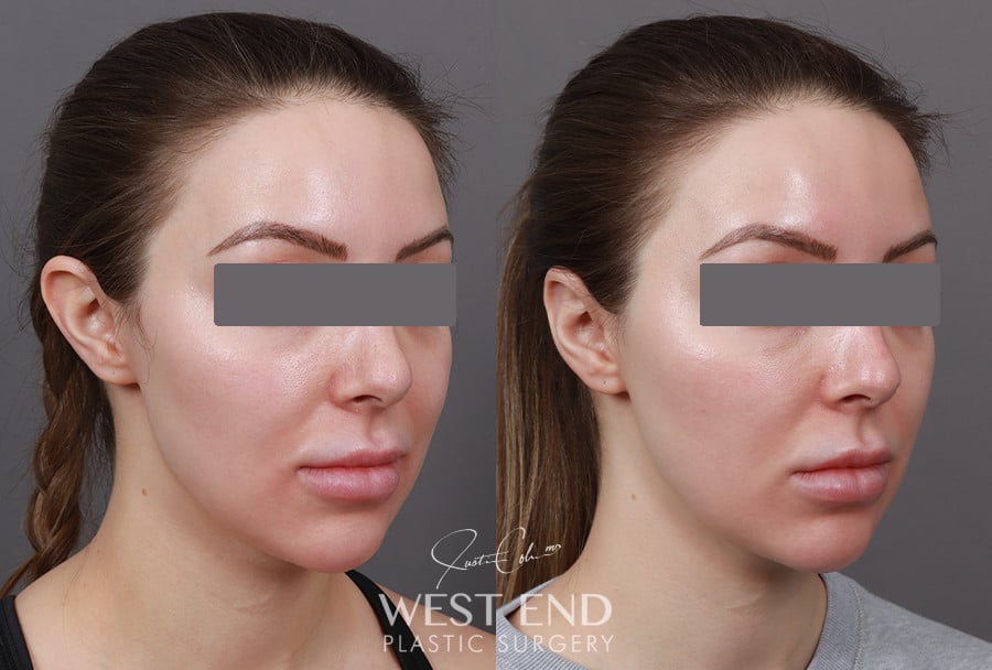 Otoplasty before photo. Individual results may vary.
