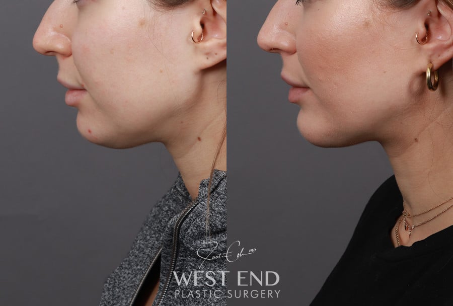 Liposuction & Chin Implant before photo. Individual results may vary.