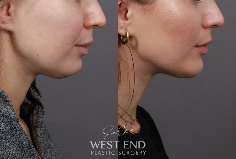 Liposuction & Chin Implant before photo. Individual results may vary.