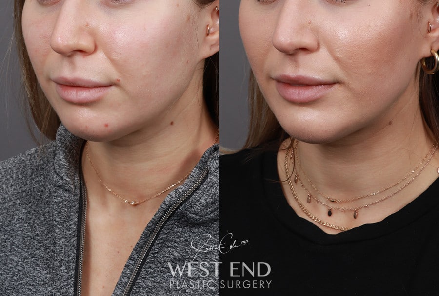 Liposuction & Chin Implant before photo. Individual results may vary.