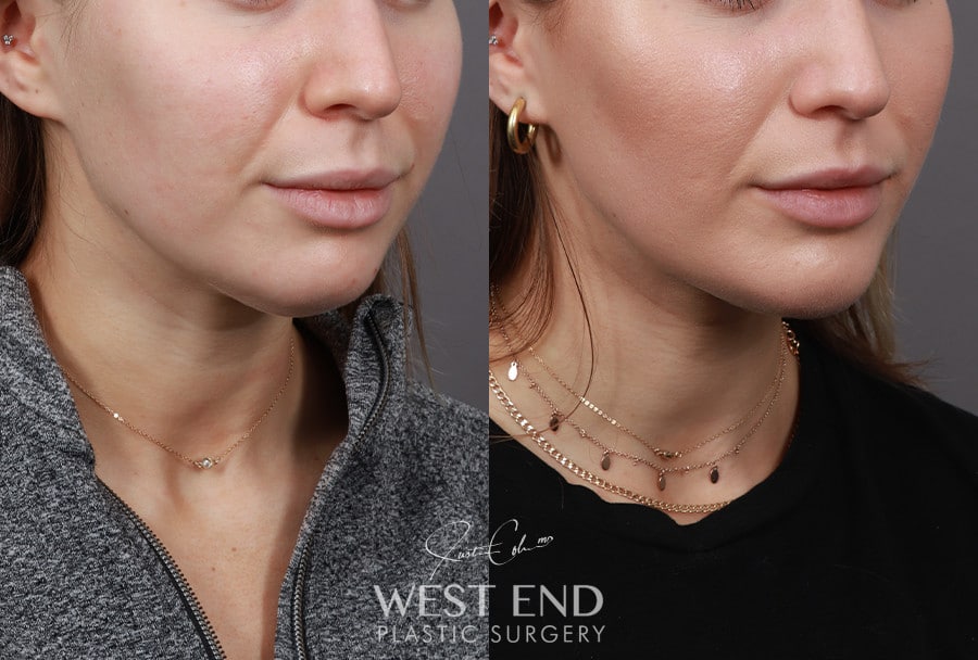 Liposuction & Chin Implant before photo. Individual results may vary.