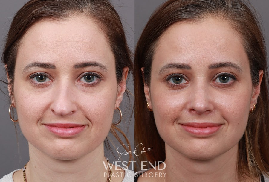 Rhinoplasty & Lower Blepharoplasty before photo. Individual results may vary.