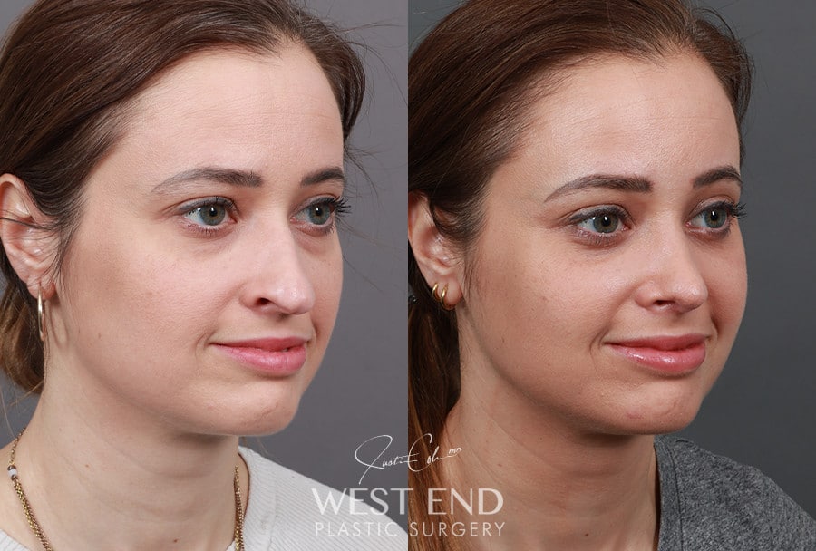 Rhinoplasty & Lower Blepharoplasty before photo. Individual results may vary.