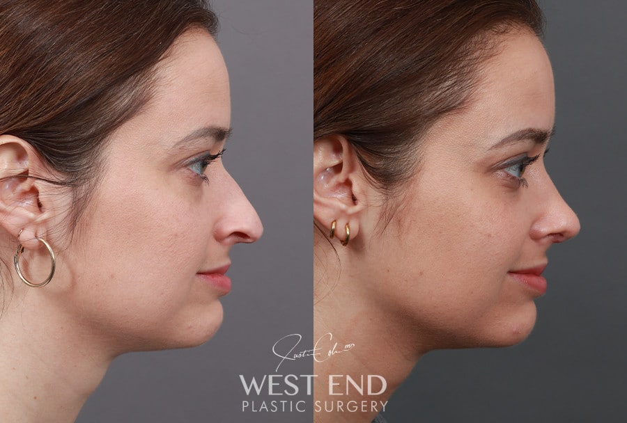 Rhinoplasty & Lower Blepharoplasty before photo. Individual results may vary.