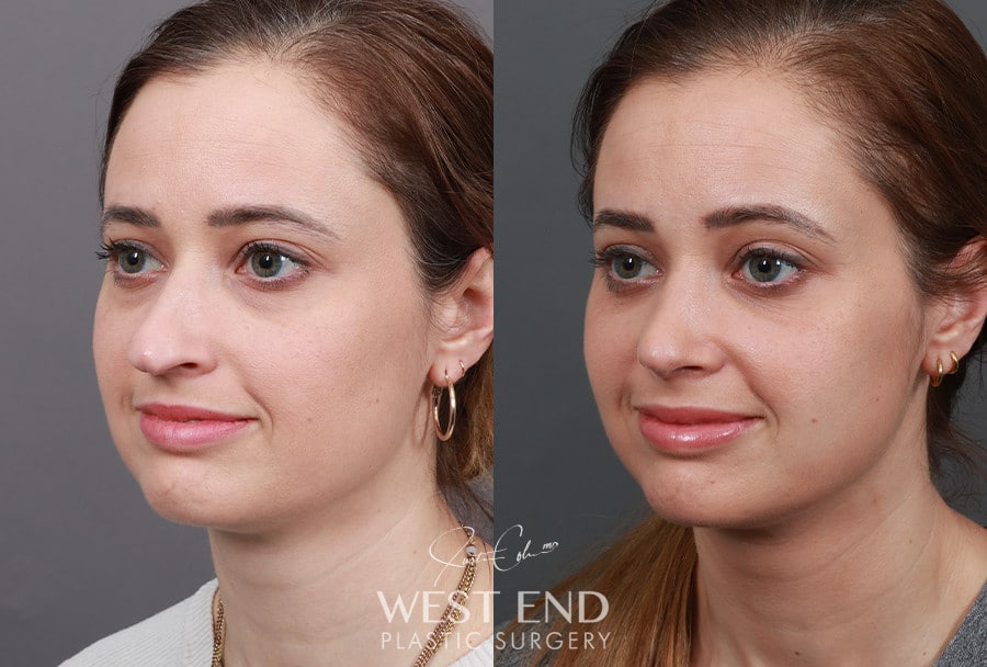 Rhinoplasty & Lower Blepharoplasty before photo. Individual results may vary.