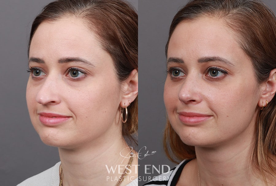 Rhinoplasty & Lower Blepharoplasty before photo. Individual results may vary.