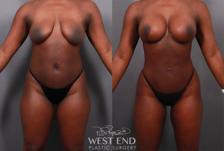 Breast Lift with Breast Implants before photo. Individual results may vary.