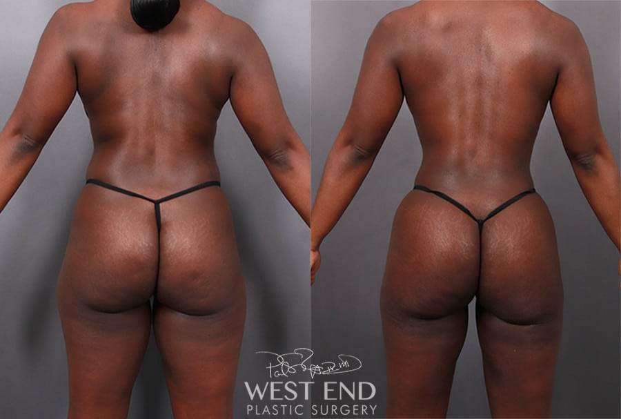 Brazilian Butt Lift, Liposuction & Renuvion Skin Tightening
