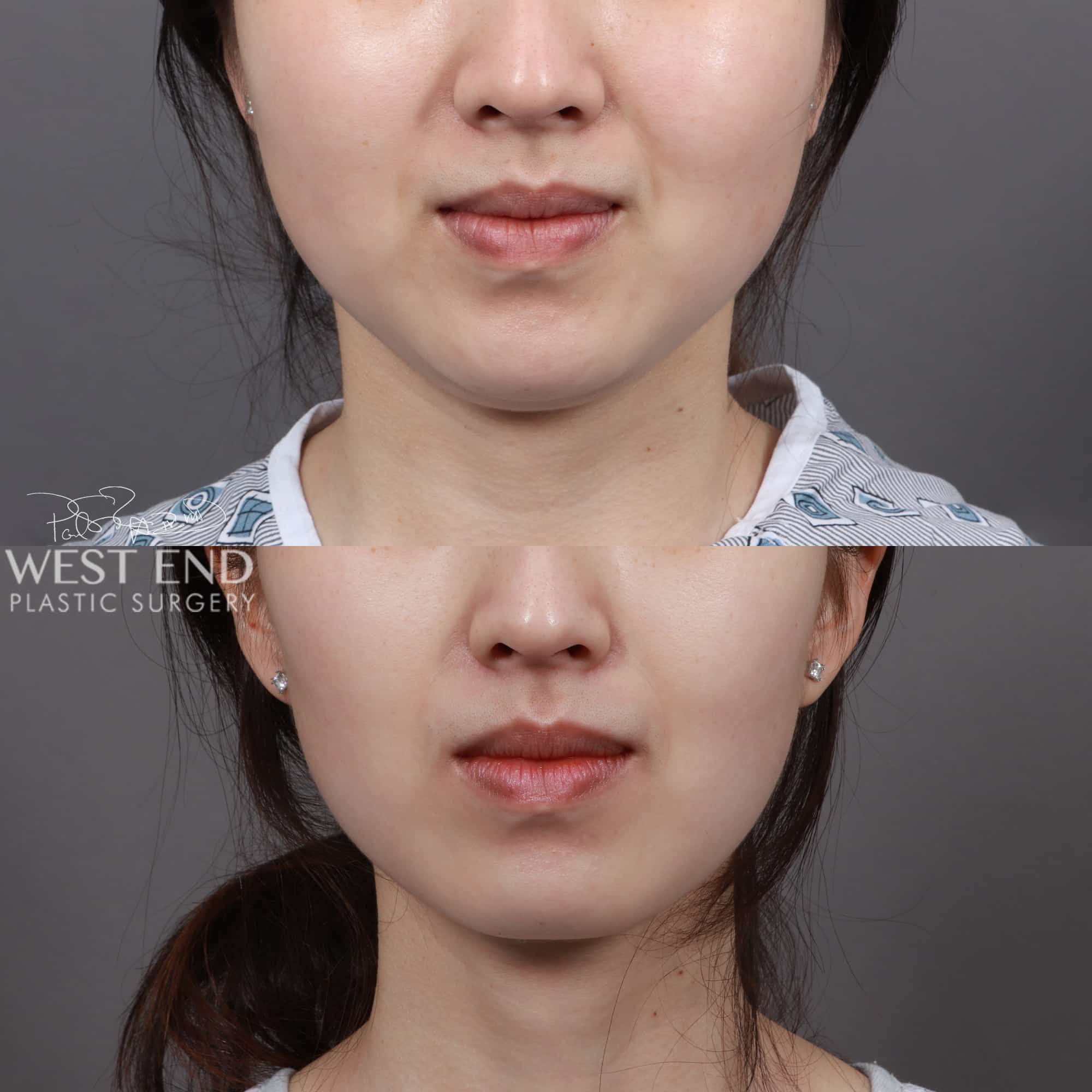 Liposuction & Buccal Fat Pad Removal