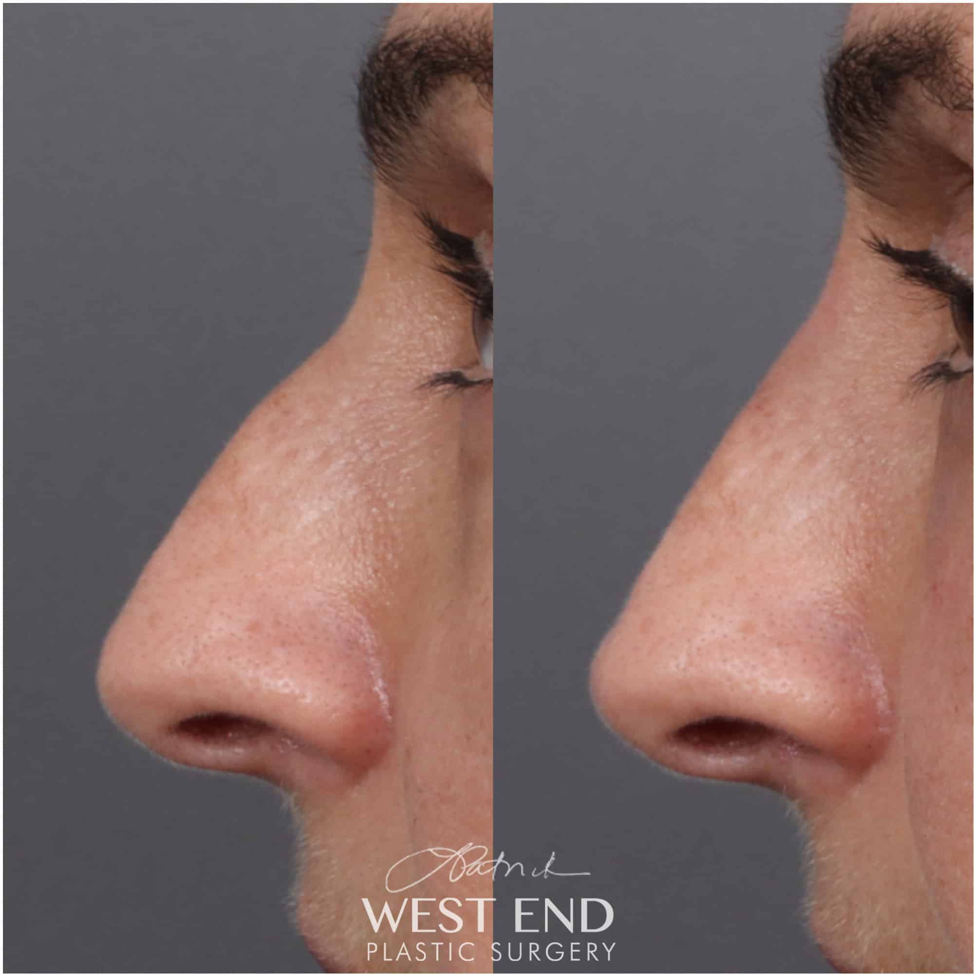 Non-Surgical Rhinoplasty