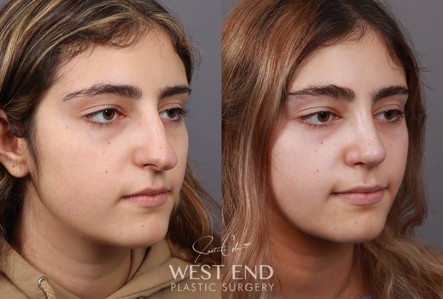 Rhinoplasty before photo. Individual results may vary.