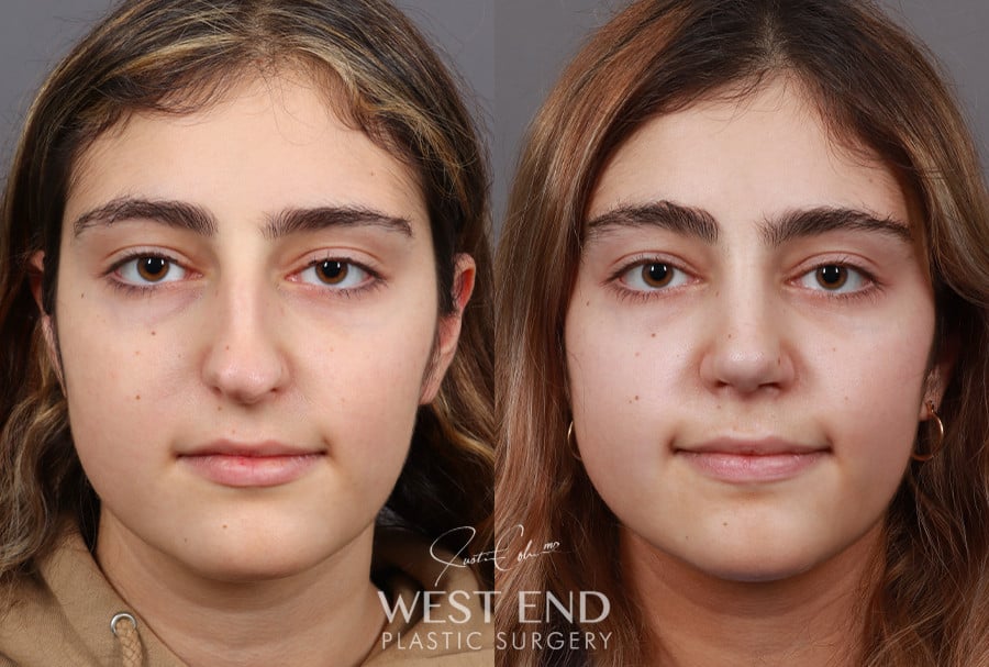 Rhinoplasty before photo. Individual results may vary.