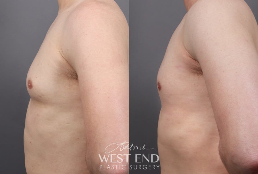 Gynecomastia (using Liposuction & Renuvion)