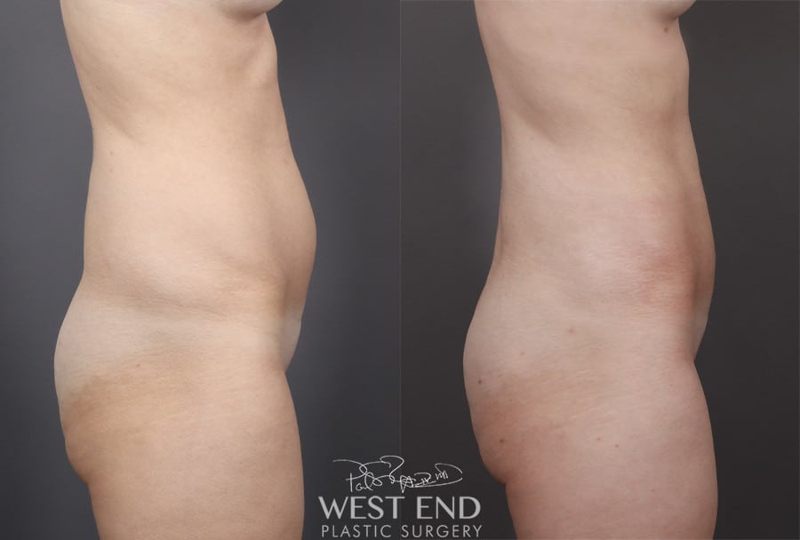 Liposuction and Renuvion Skin Tightening (6 Months Post-Op)
