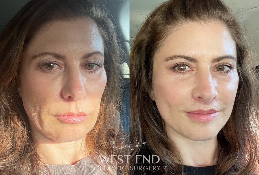 Extended Deep Plane Facelift, Neck Lift, Temporal Brow Lift, Blepharoplasty, & Lip Lift before photo. Individual results may vary.
