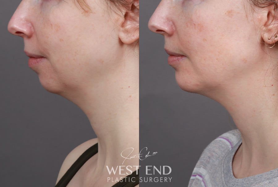 Chin Implant before photo. Individual results may vary.
