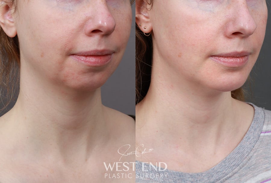 Chin Implant before photo. Individual results may vary.