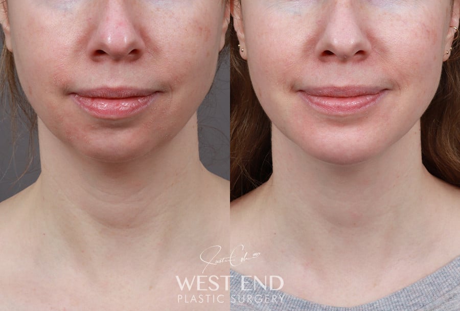 Chin Implant before photo. Individual results may vary.