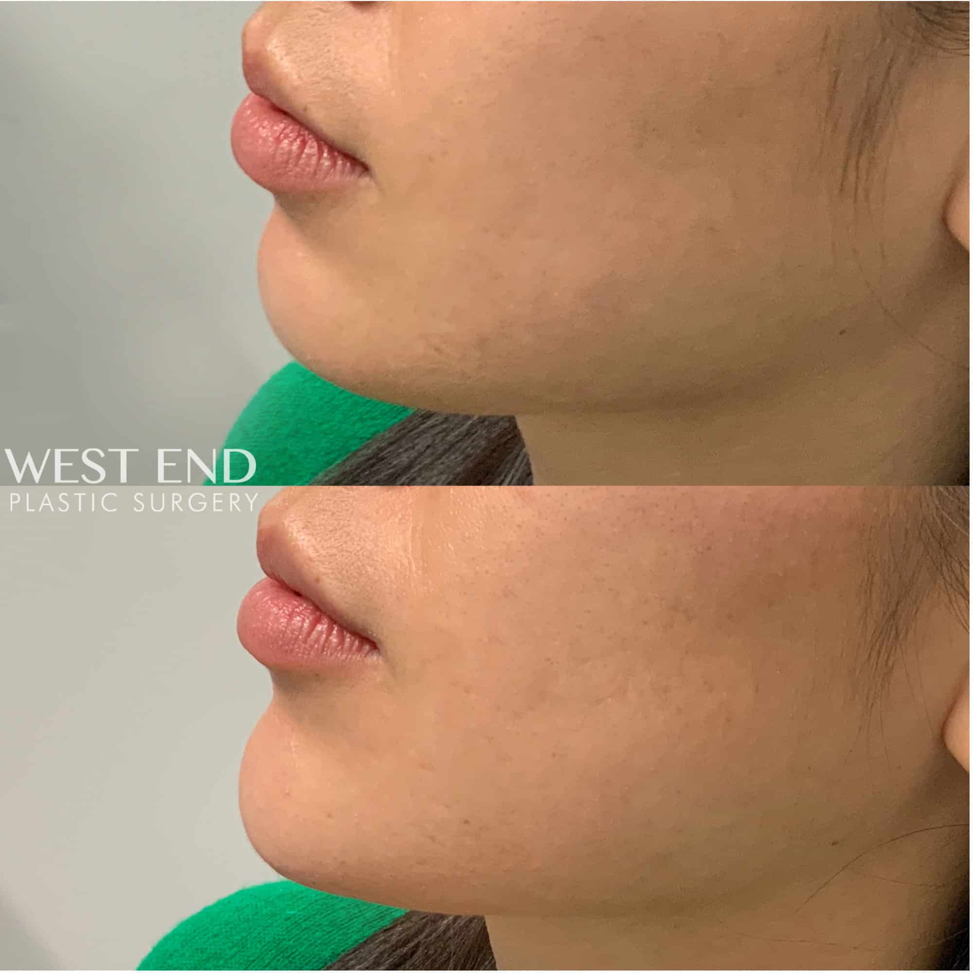 Chin Filler