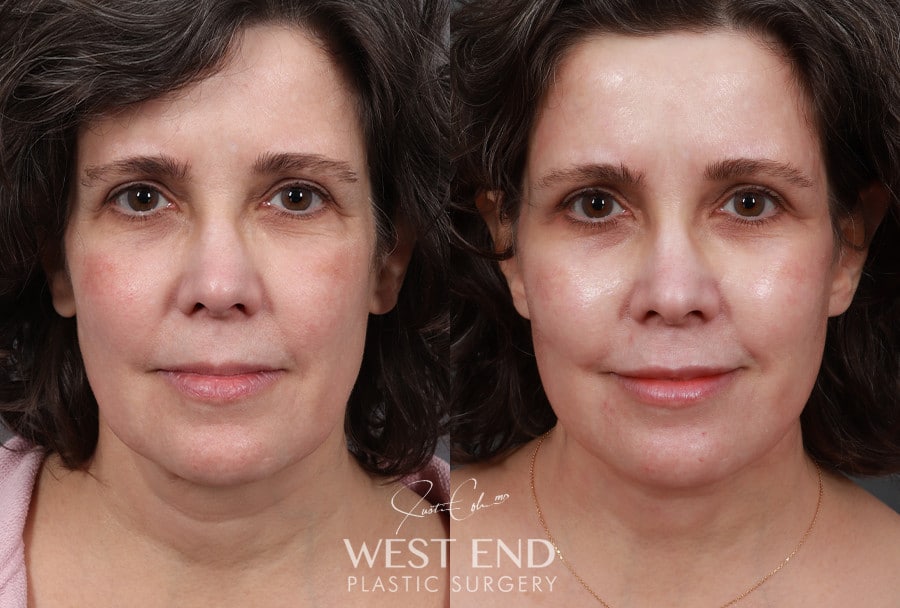Revision Extended Deep Plane Facelift & Neck Lift with Platysmaplasty before photo. Individual results may vary.