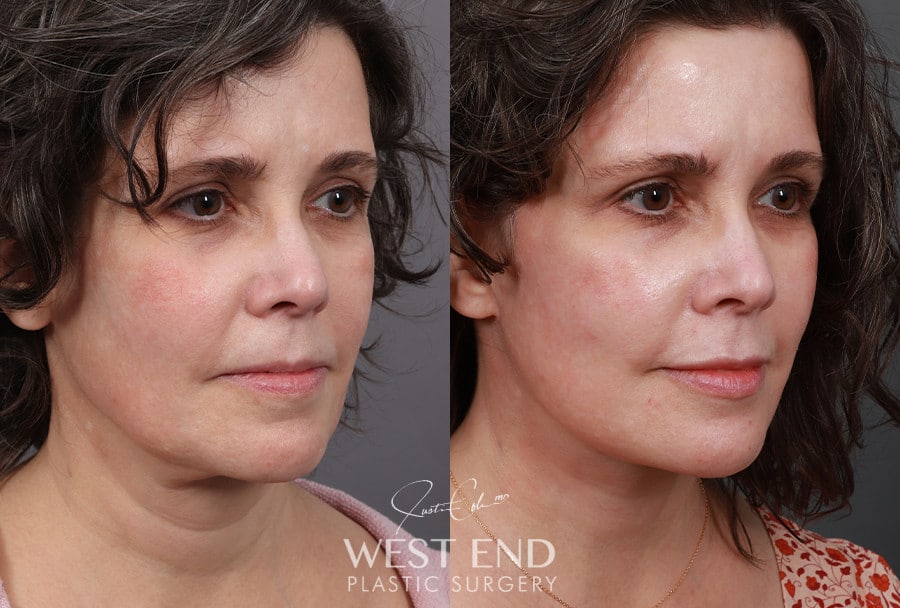 Revision Extended Deep Plane Facelift & Neck Lift with Platysmaplasty before photo. Individual results may vary.