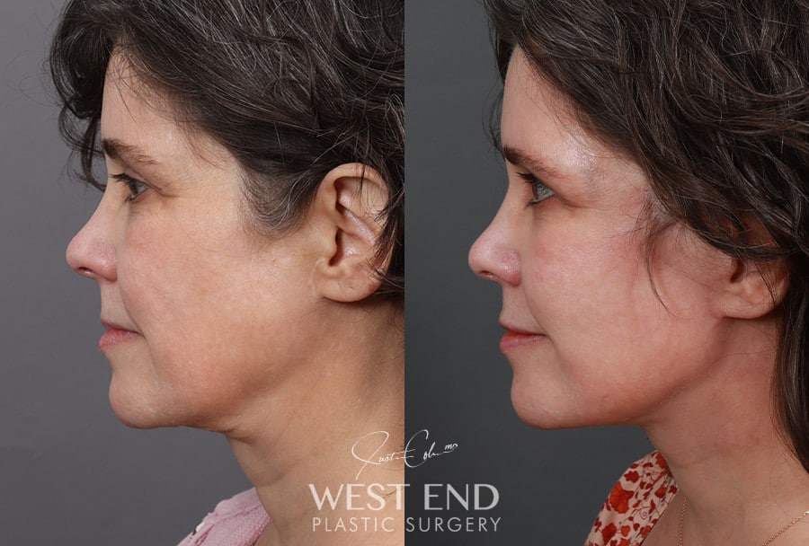 Revision Extended Deep Plane Facelift & Neck Lift with Platysmaplasty before photo. Individual results may vary.