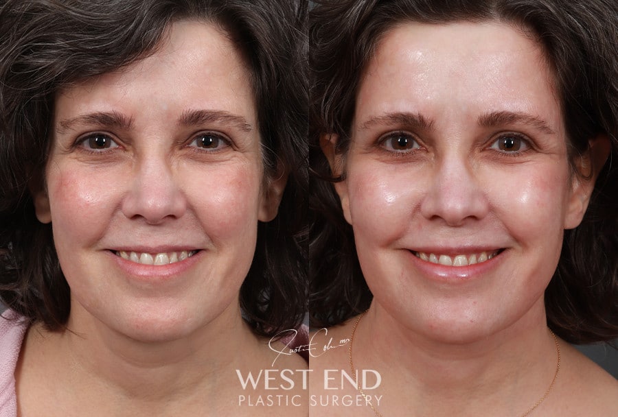Revision Extended Deep Plane Facelift & Neck Lift with Platysmaplasty before photo. Individual results may vary.
