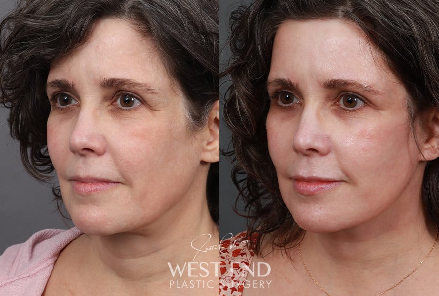 Revision Extended Deep Plane Facelift & Neck Lift with Platysmaplasty before photo. Individual results may vary.