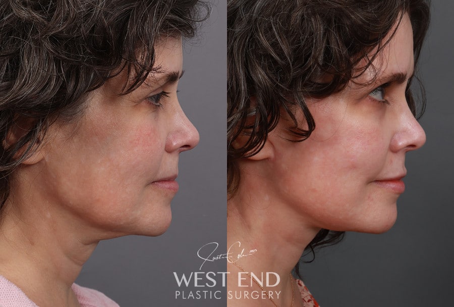 Revision Extended Deep Plane Facelift & Neck Lift with Platysmaplasty before photo. Individual results may vary.