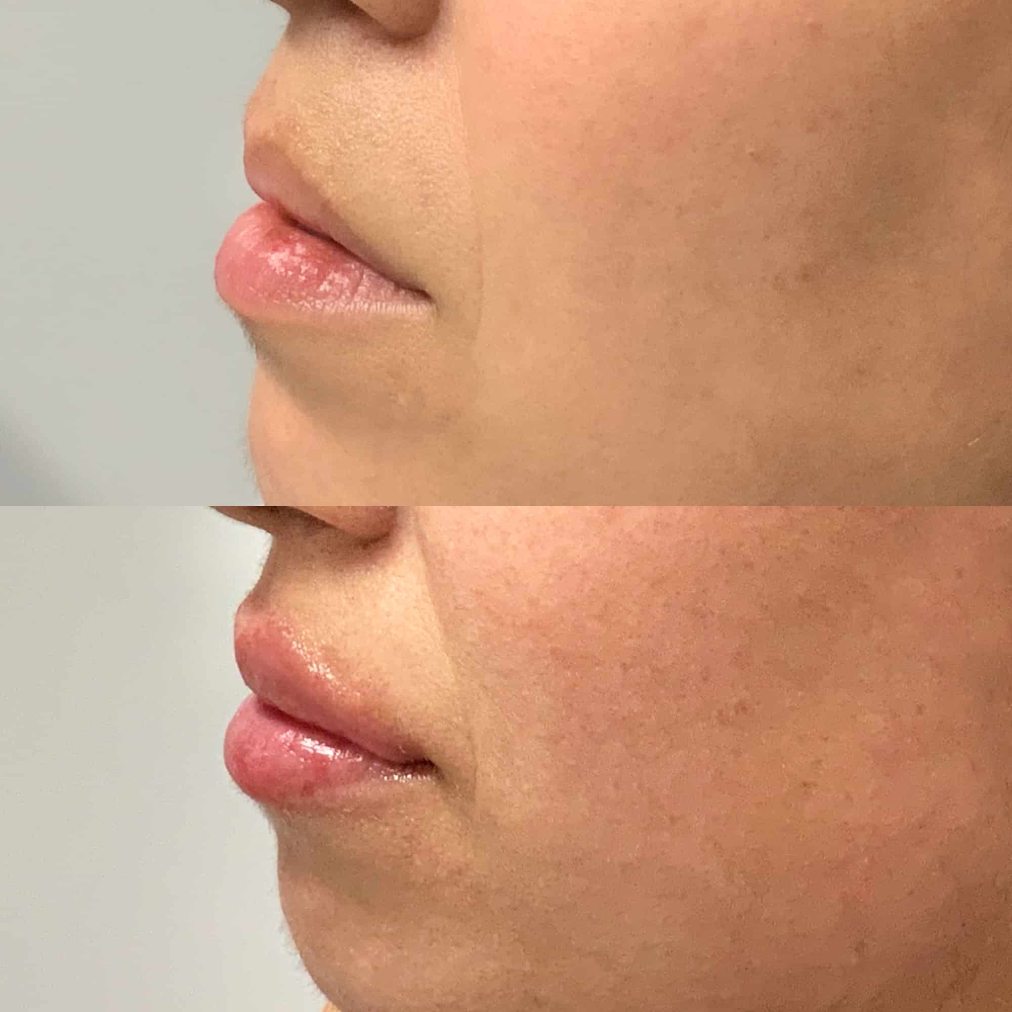 Lip Filler