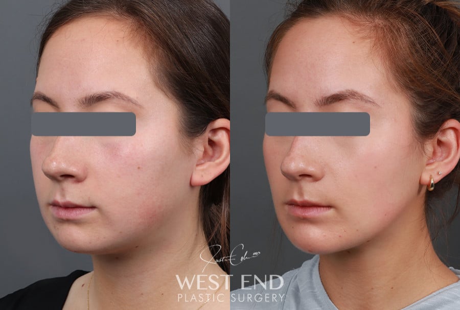 Neck Liposuction, Buccal Fat Reduction, & Chin Implant before photo. Individual results may vary.
