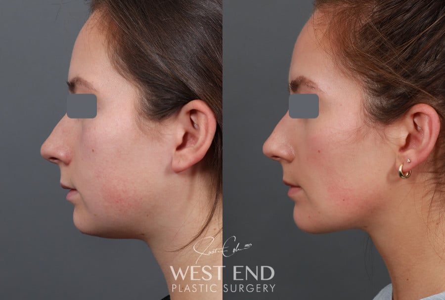 Neck Liposuction, Buccal Fat Reduction, & Chin Implant before photo. Individual results may vary.