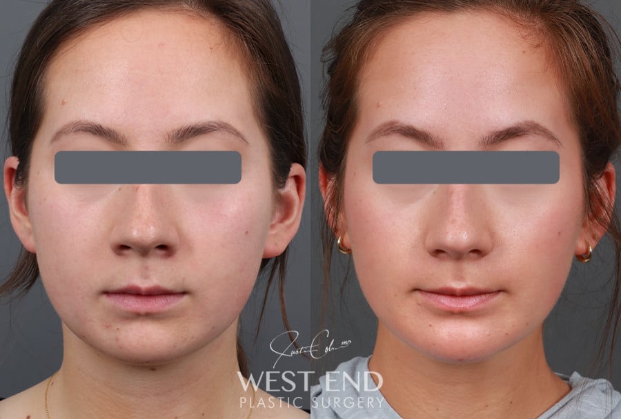 Neck Liposuction, Buccal Fat Reduction, & Chin Implant before photo. Individual results may vary.