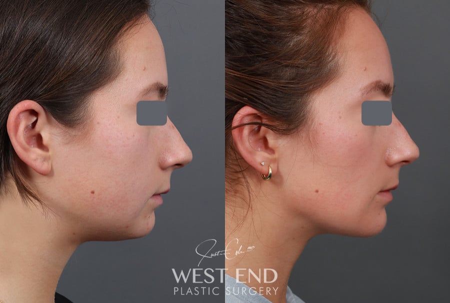 Neck Liposuction, Buccal Fat Reduction, & Chin Implant before photo. Individual results may vary.