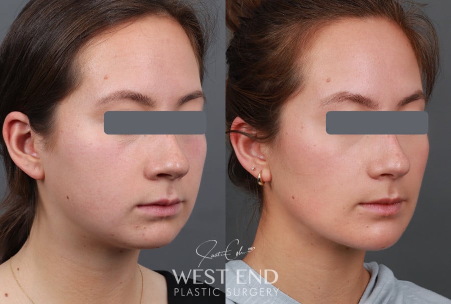 Neck Liposuction, Buccal Fat Reduction, & Chin Implant before photo. Individual results may vary.